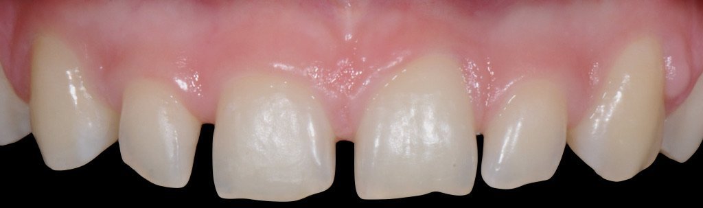 Closing front gaps 1