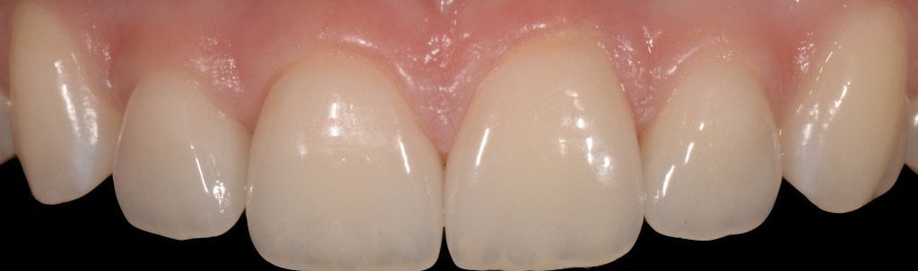 Closing front gaps 2
