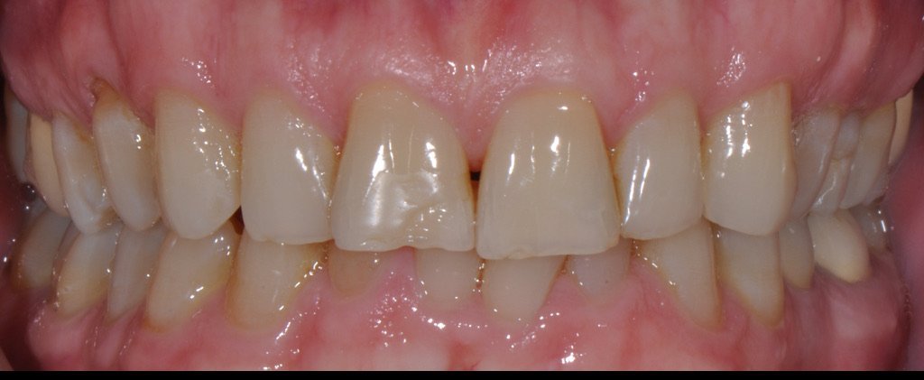 Full smile renewal 1