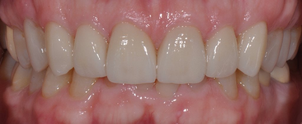 Full smile renewal 2