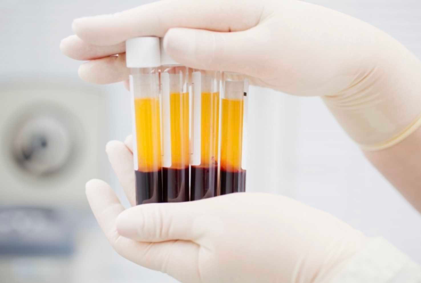 PRF & CGF therapy